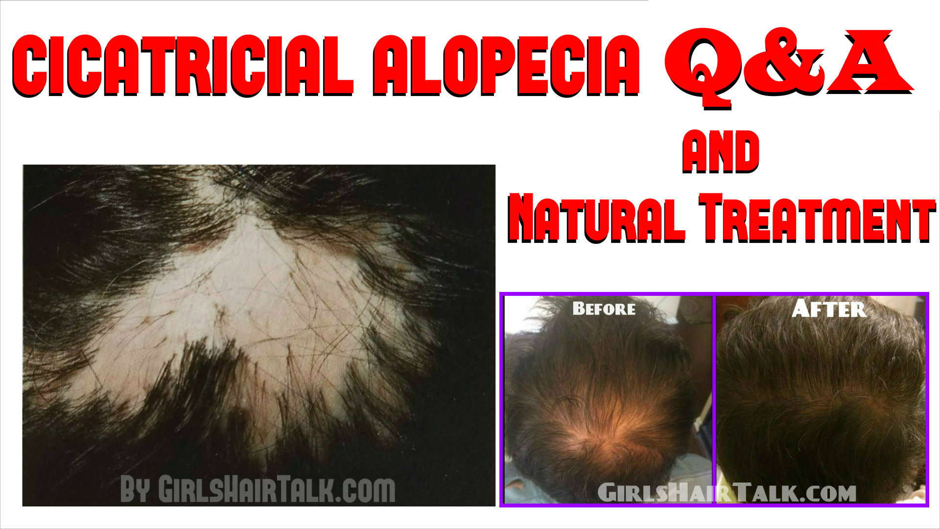 how to treat scarring alopecia naturally