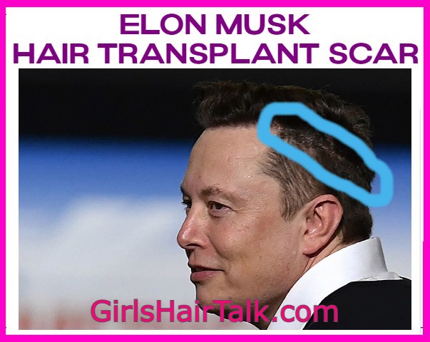 Elon Musk Hair Transplant Scar