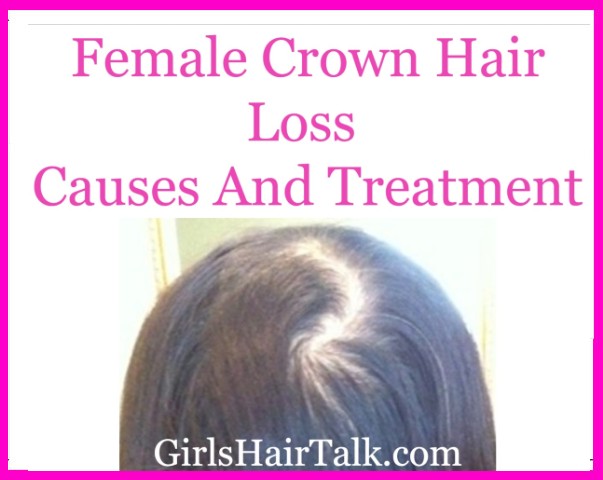 Women's hair loss thinning on top of head.