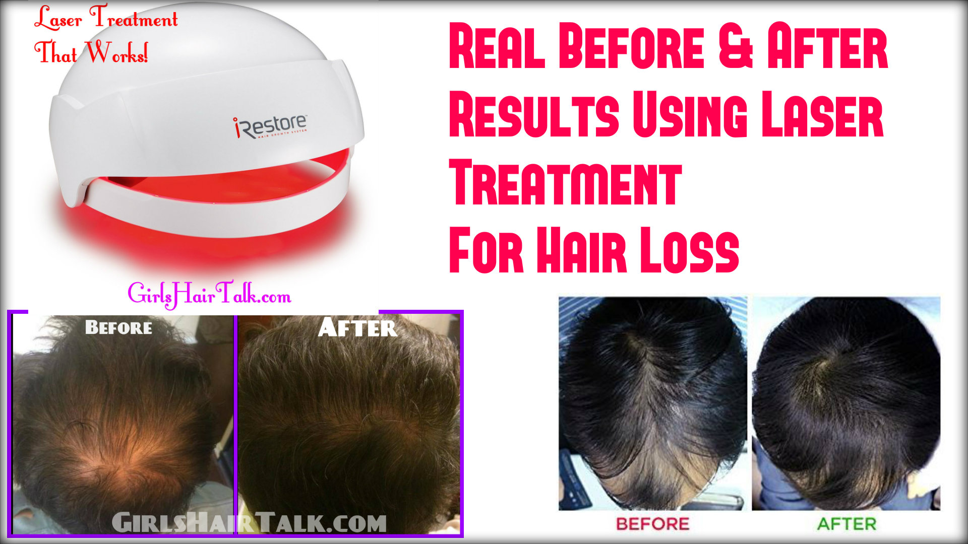 33+ Laser Light For Hair Growth Pics