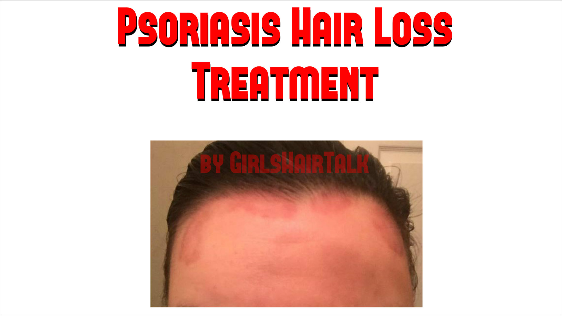 Psoriasis Hair Loss Treatment For Women