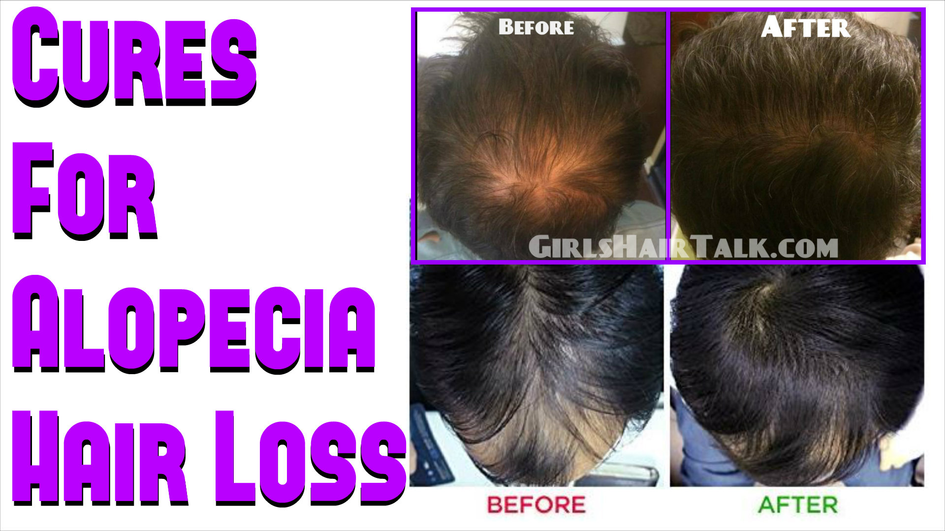 Cures For Alopecia Home Remedies With Before And After Pictures