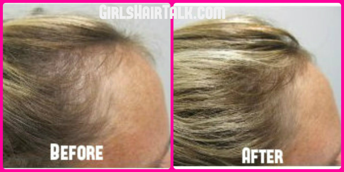 Before and after of women's hair loss on the left and an after picture of regrowth on the right.