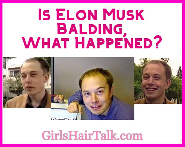 Is Elon Musk Balding?