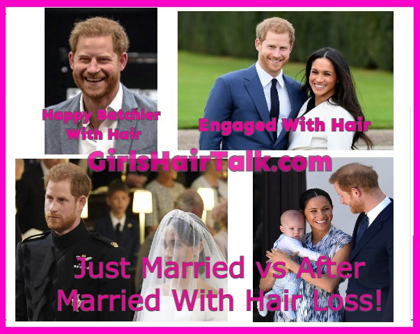 Prince-Harry-Time-Line-Bald