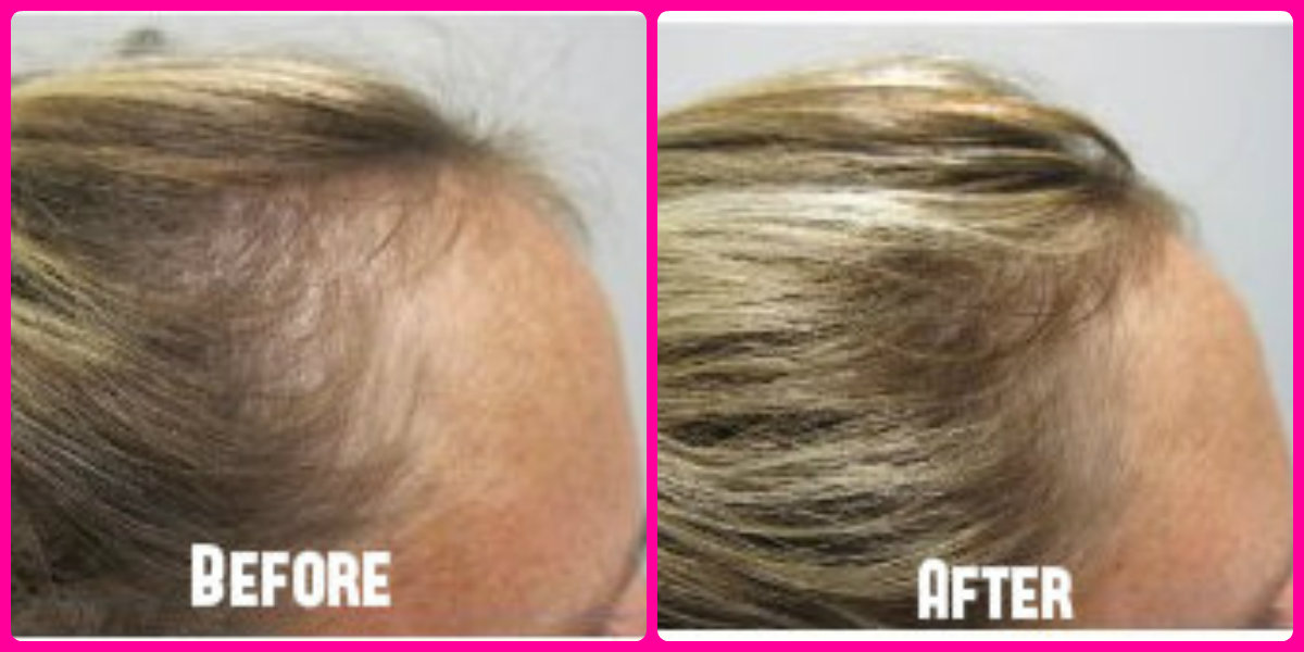 Before and after of hair regrowth.