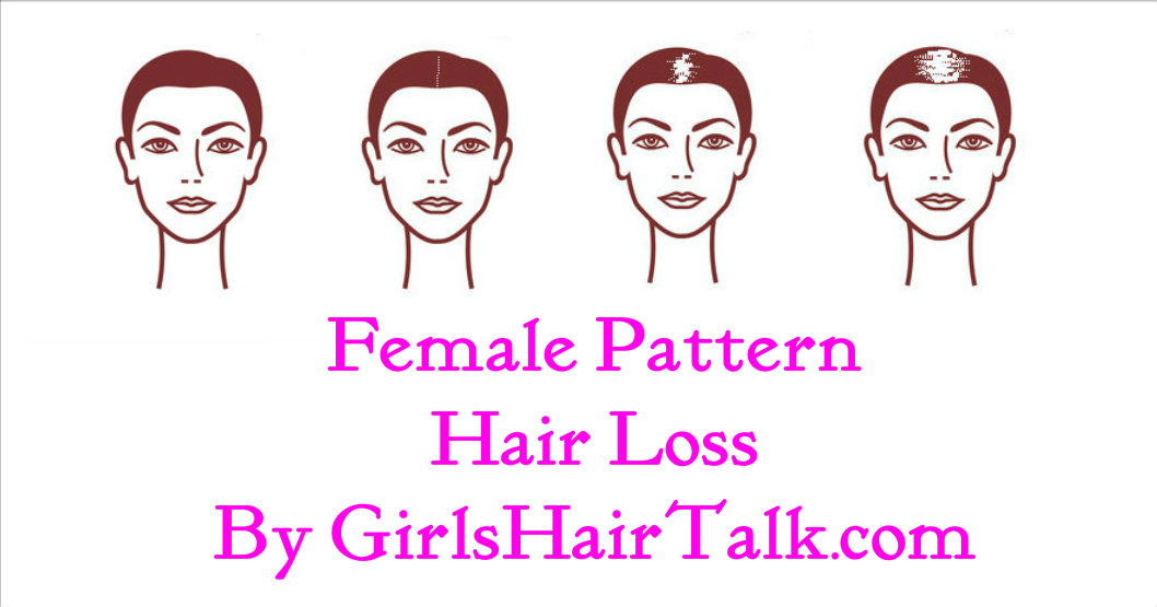 Female hair loss chart with pictures of the various stages regarding female hair loss.