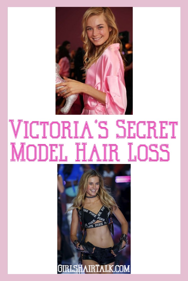 Victoria's Secret Model Celebrity Female Hair Loss